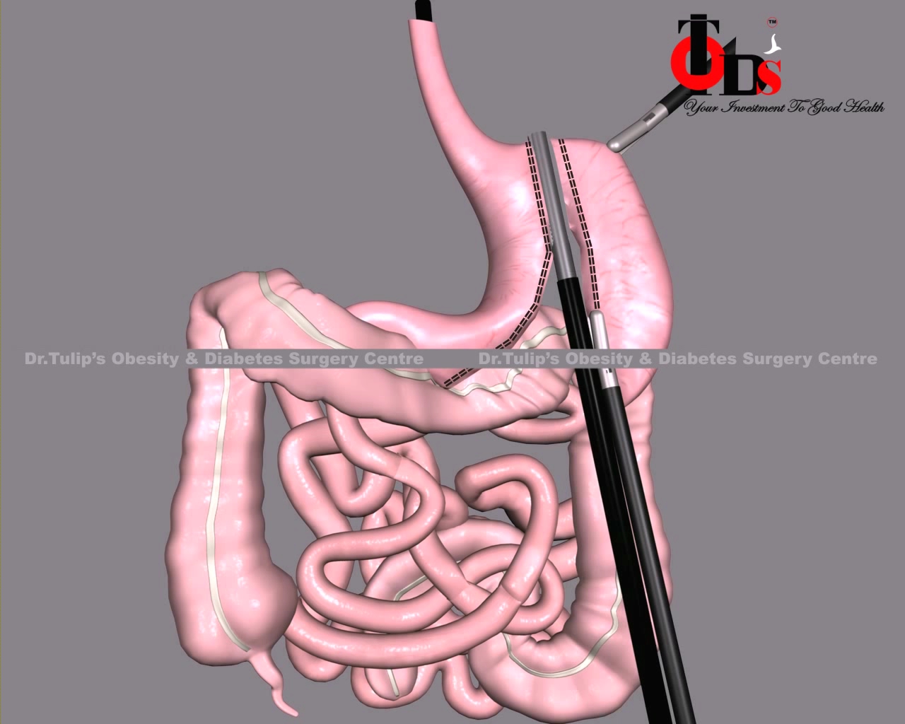 Ileal Interposition Surgery